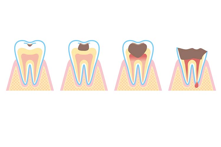 虫歯進行イメージ