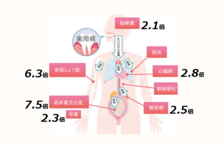 虫歯や歯周病の赤ちゃんへの影響イメージ