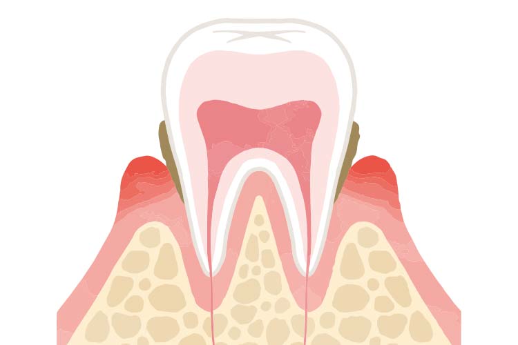 歯周病イメージ